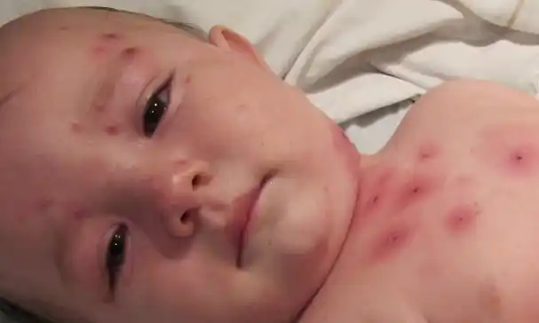 La vacuna contra el sarampión está disponible en los centros de salud