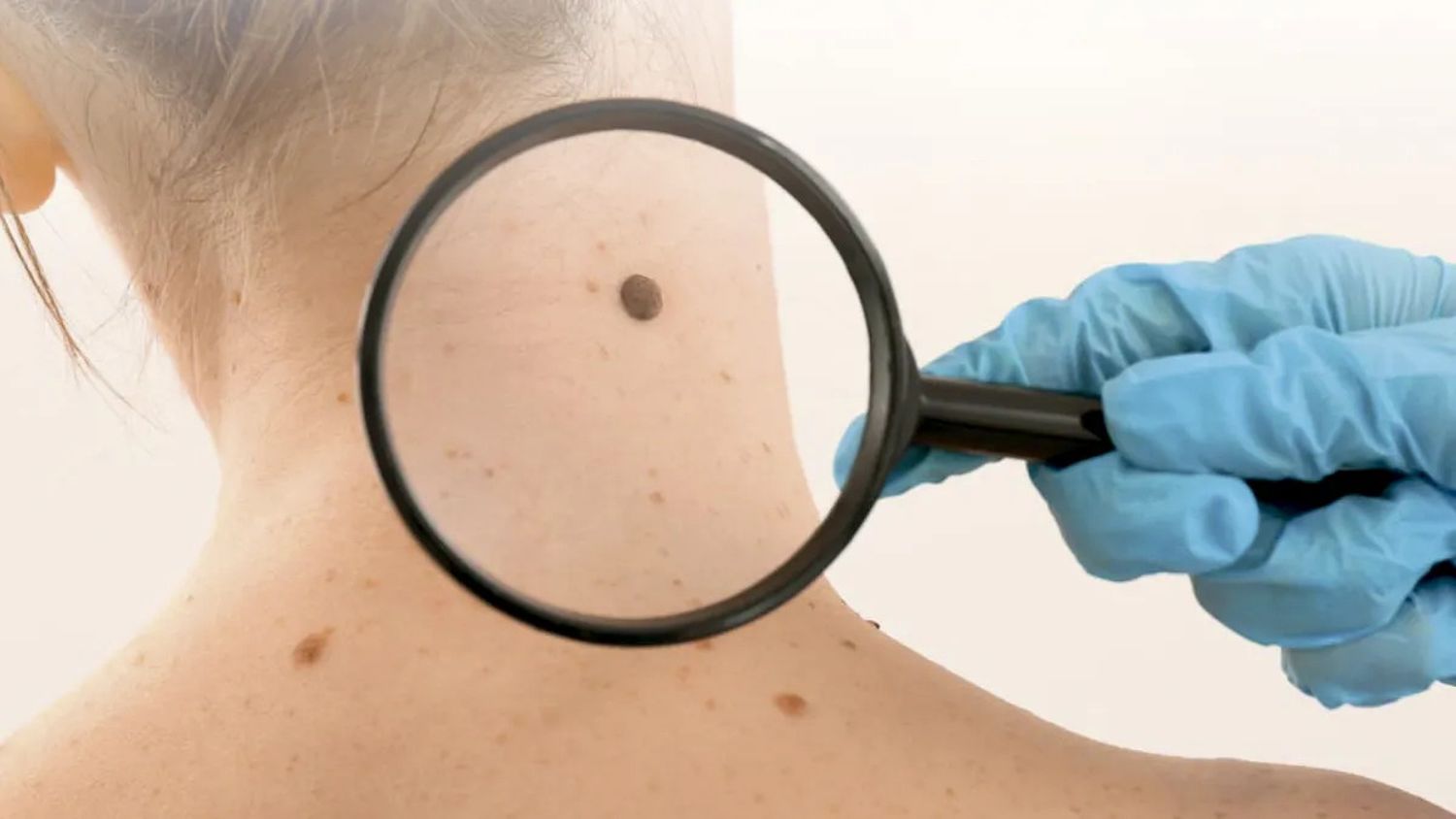 Chequear los lunares es clave para prevenir el melanoma