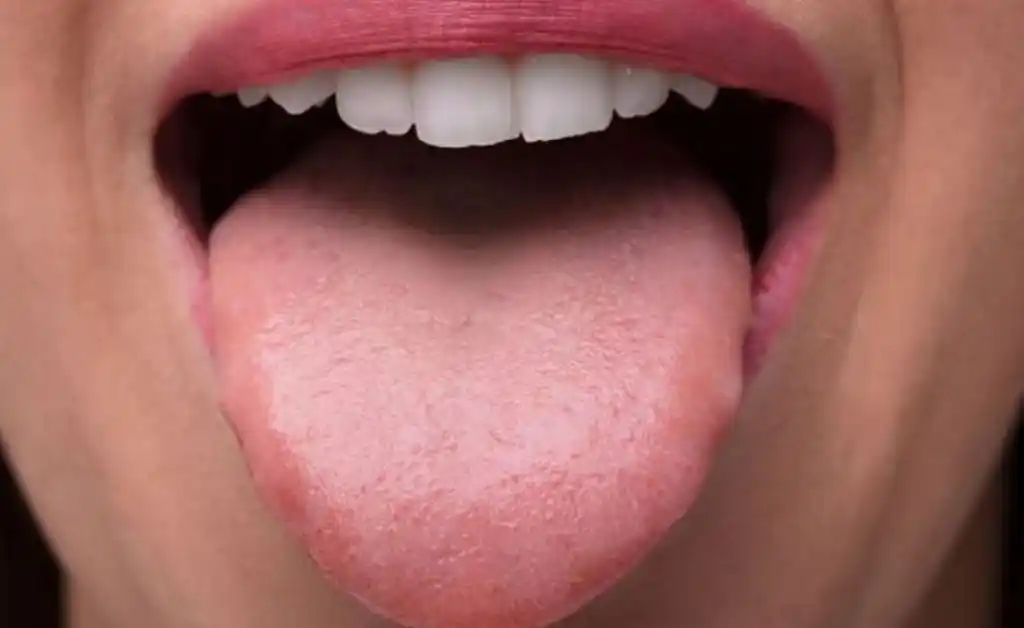 “Lengua covid”: infectólogos alertan sobre un nuevo síntoma