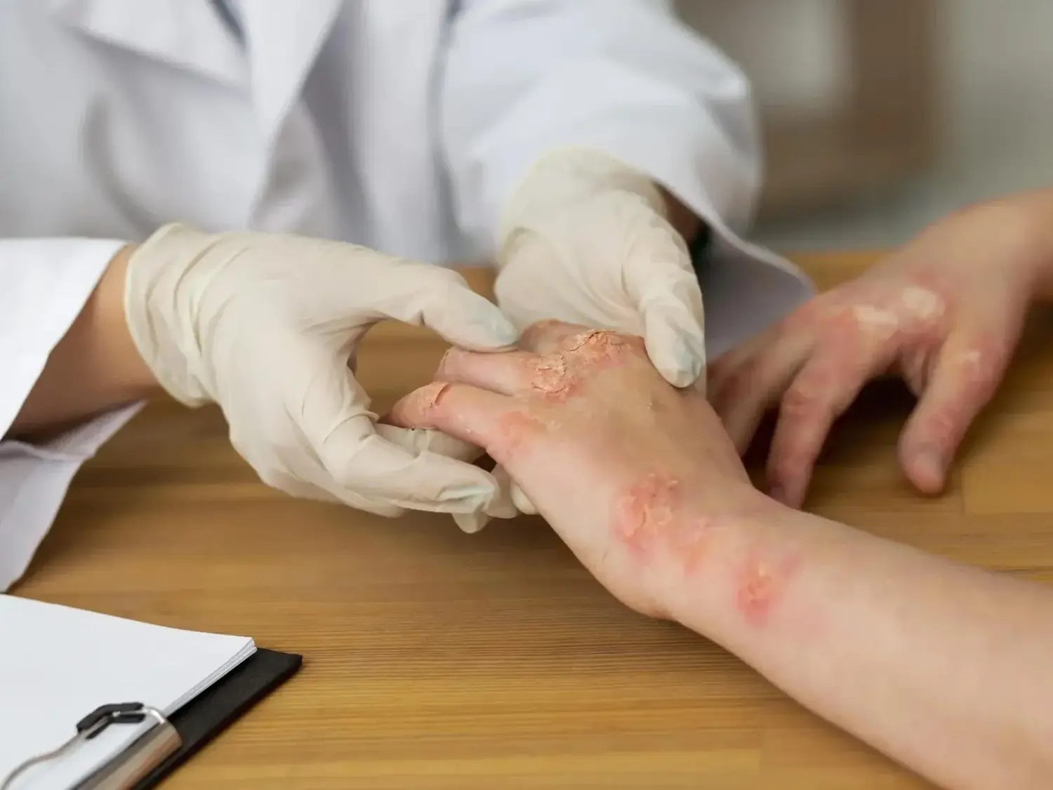 Psoriasis: tener poca piel afectada no siempre significa una enfermedad leve