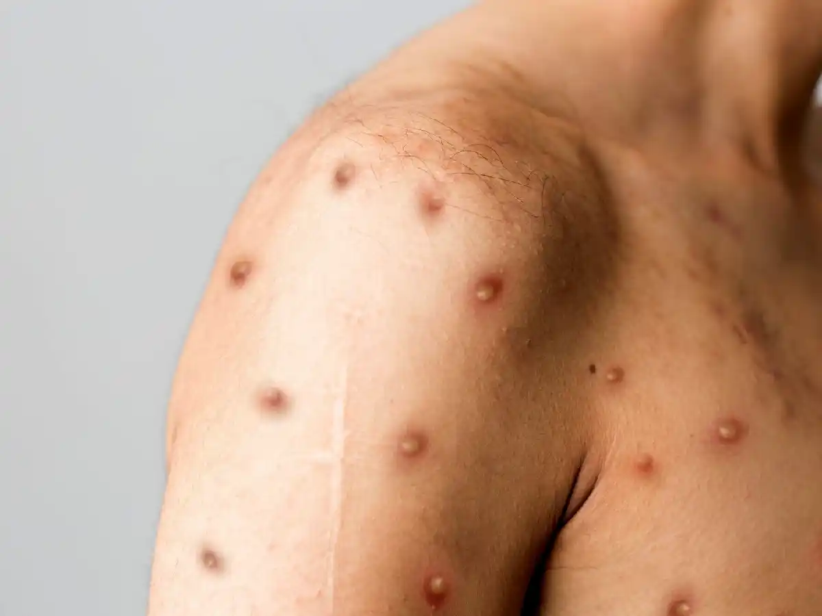 Confirman el segundo caso de viruela del mono en Argentina