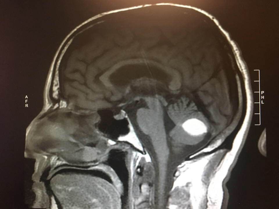 Médicos quedan perplejos cuando tumor cerebral desaparece antes de la cirugía