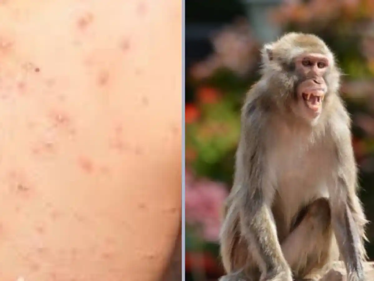 Viruela del mono: todo lo que hay que saber de la extraña enfermedad que preocupa a Europa y Estados Unidos