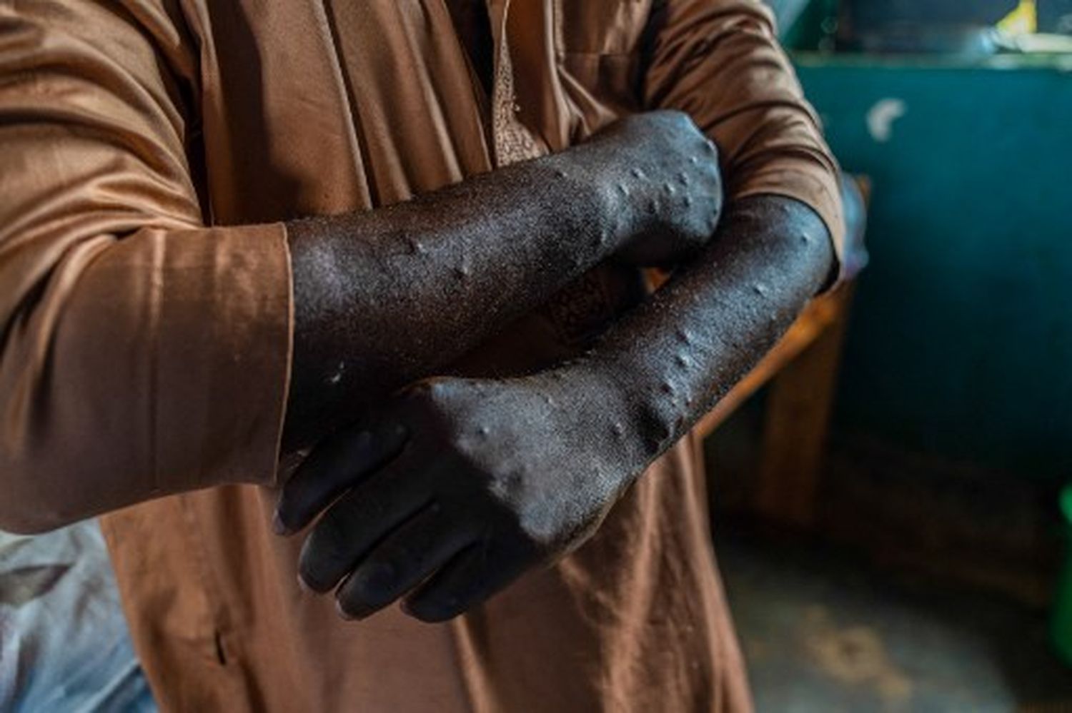 Aprueban el primer test PARA DIAGNOSTICAR LA MPOX: anuncio de la OMS