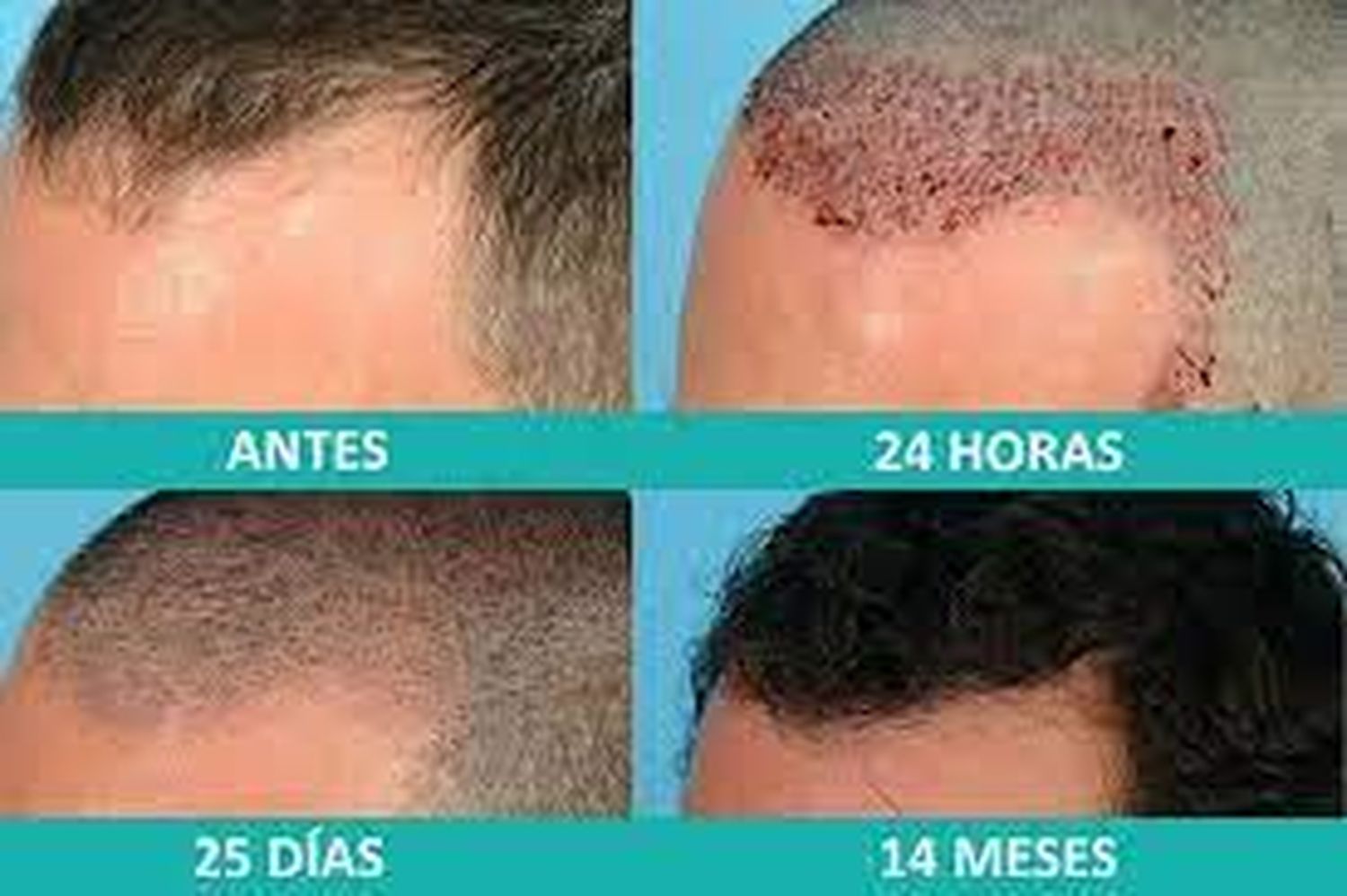 Tratamiento Quirurgico Mininvasivo de la Alopecia