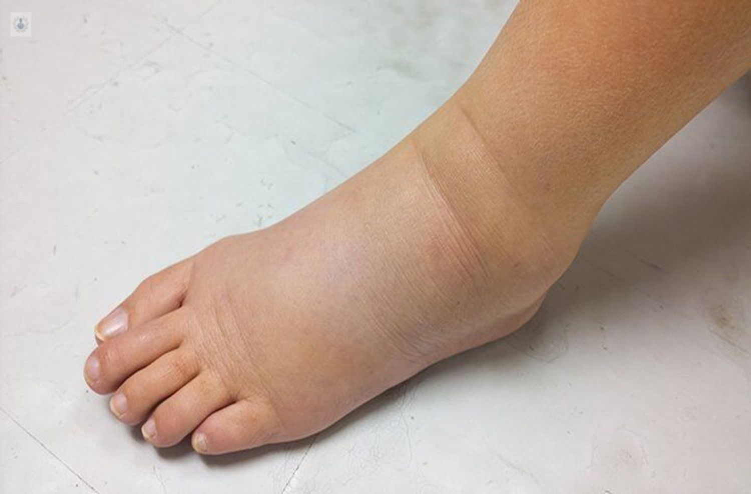 Piernas: Cómo prevenir el edema