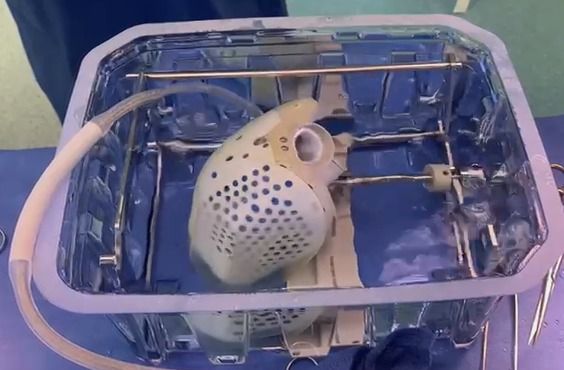 ASÍ LOGRARON trasplantar un corazón  artificial para salvar la vida de un hombre
