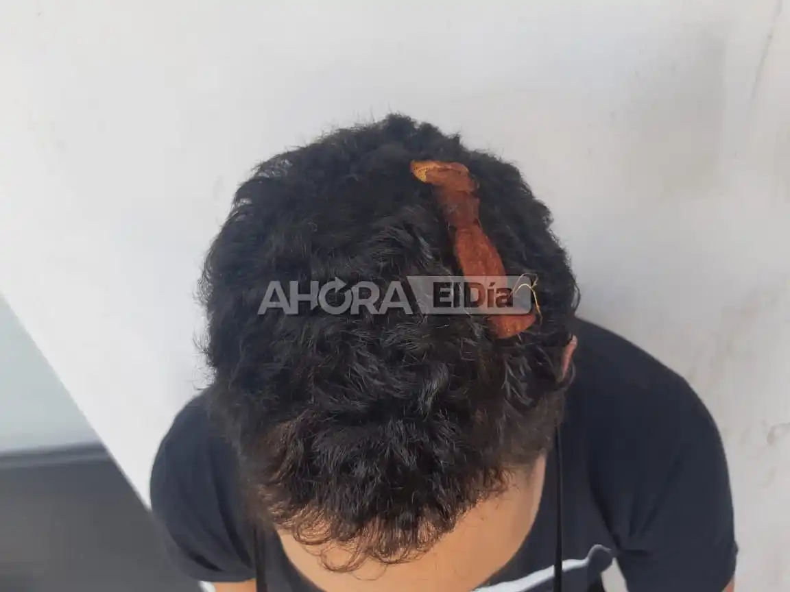 Así le quedó la herida al turista accidentado en el Corsódromo: las imágenes