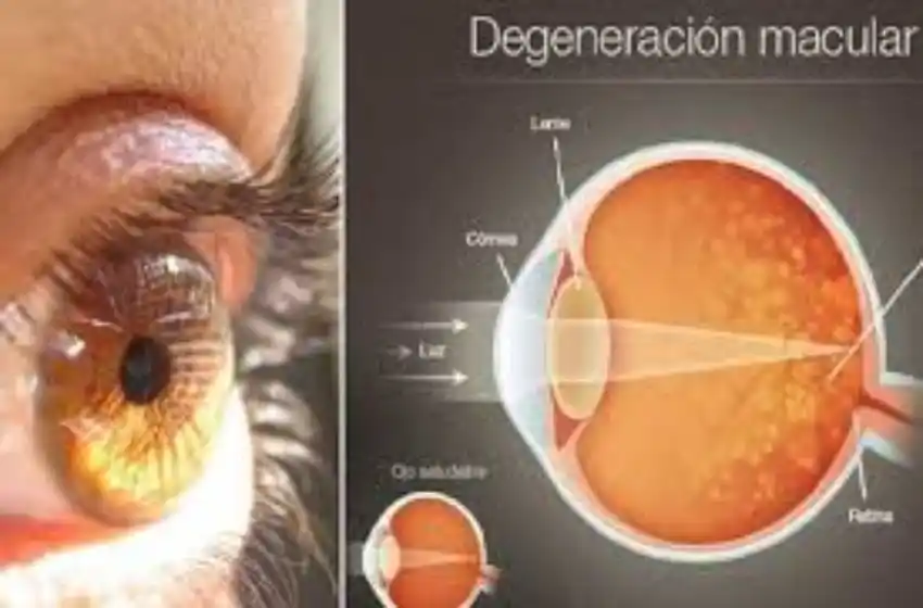 Innovador tratamiento para la degeneración macular seca