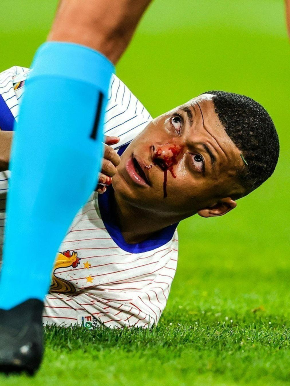 Kylian Mbappé: ¿Qué máscara usará tras fracturarse la nariz en la Eurocopa?