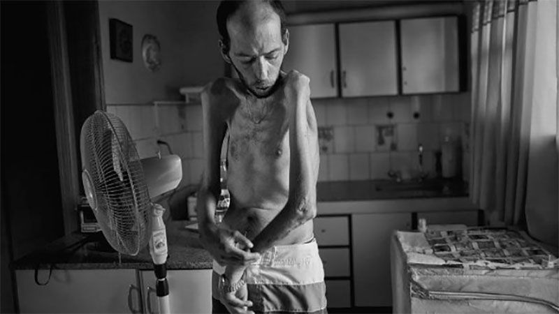 Por los agroquímicos padece neuropatía tóxica y atrofia muscular