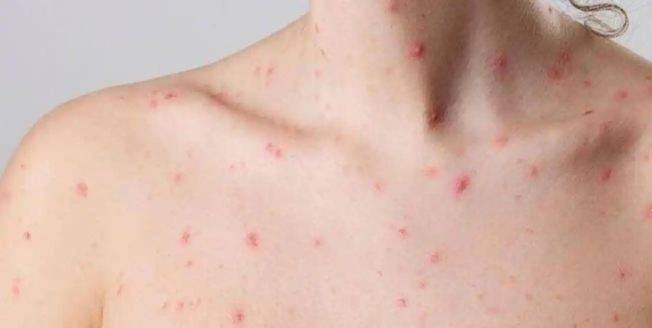 Confirmaron el primer caso de la nueva variante de viruela símica en Argentina.