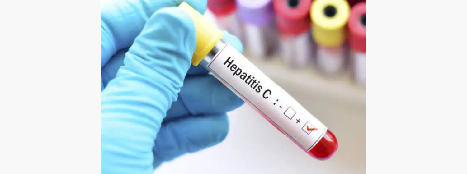 "El 78% de los casos de cáncer hepático primario es por hepatitis B o C"