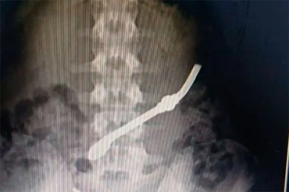 Interno de Unidad Penal de Gualeguay se tragó una bombilla en protesta por un problema familiar