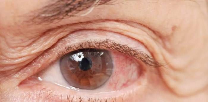 Glaucoma: una de las principales  causas de ceguera a nivel mundial