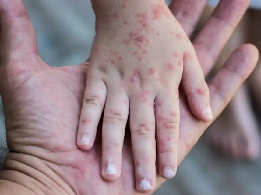 Sarampión: Refuerzan la vigilancia epidemiológica en la ciudad y piden completar la vacunación