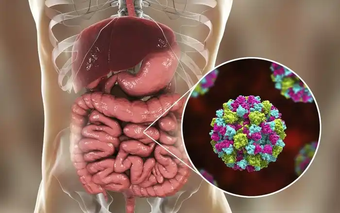 gastroenteritis jury - 1