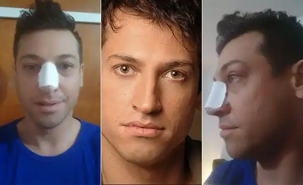 Pablo Ruiz pasó por el quirófano: “Me hice un retoque en la nariz y una lipoescultura láser en la panza y la cintura”