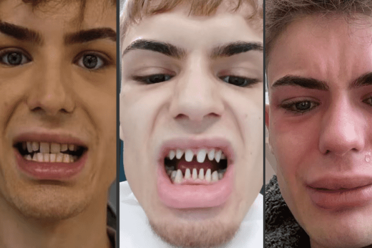 Modelo se sometió a intervención dental para mejorar su sonrisa y terminó "con dientes de tiburón"