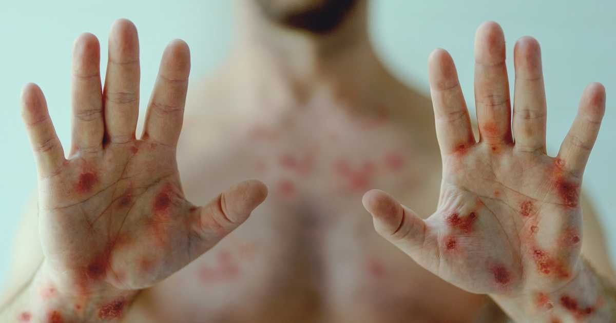 La Organización Mundial de la Salud anunció que la viruela de mono ahora se llamará “Mpox”