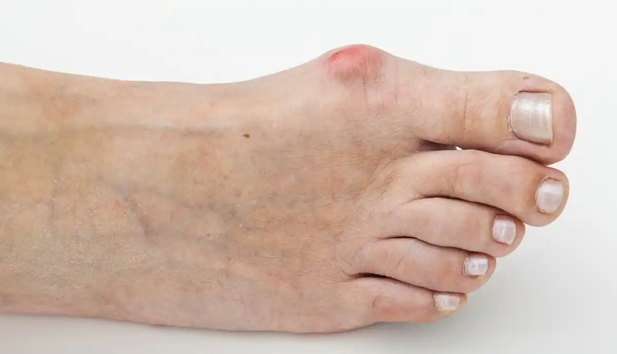 Cirugía percutánea del pie, un método para deshacerse fácil de los juanetes