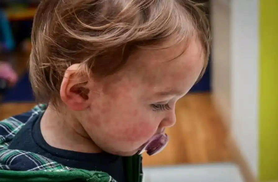 Sarampión: alerta epidemiológico en la región por un aumento exponencial de casos