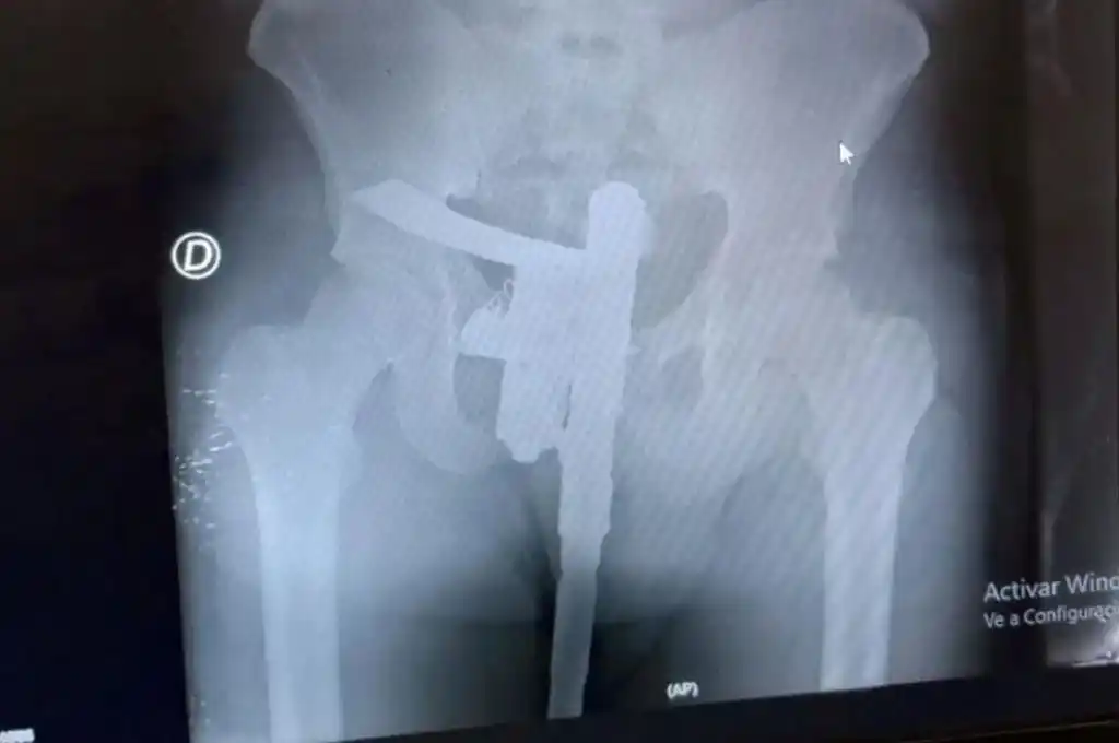 Ingresó por un accidente de transito y la radiografía mostró que ocultaba un arma de fuego