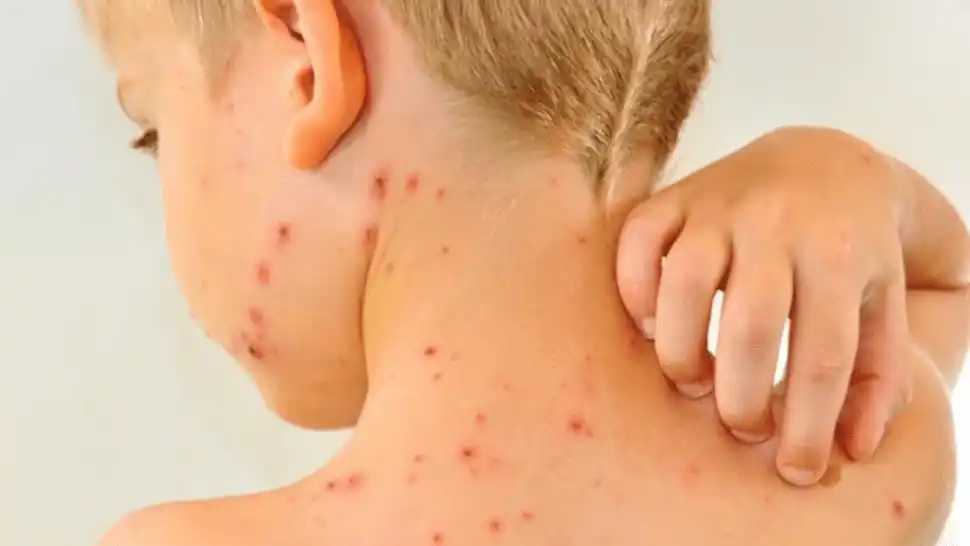 El Ministerio de Salud de la Nación emitió un alerta ante un posible ingreso de sarampión al país