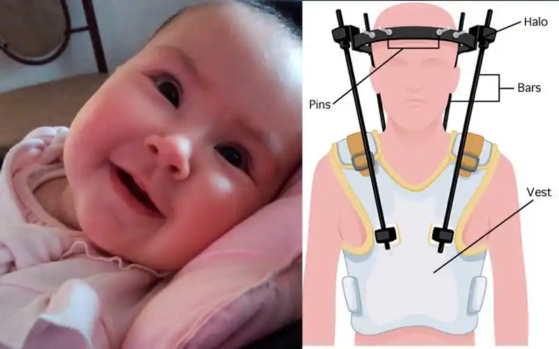 Todos por Amélie: necesita un halo chaleco para un nueva cirugía