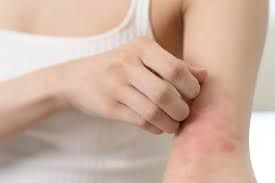 Campaña nacional de detección gratuita de dermatitis atópica