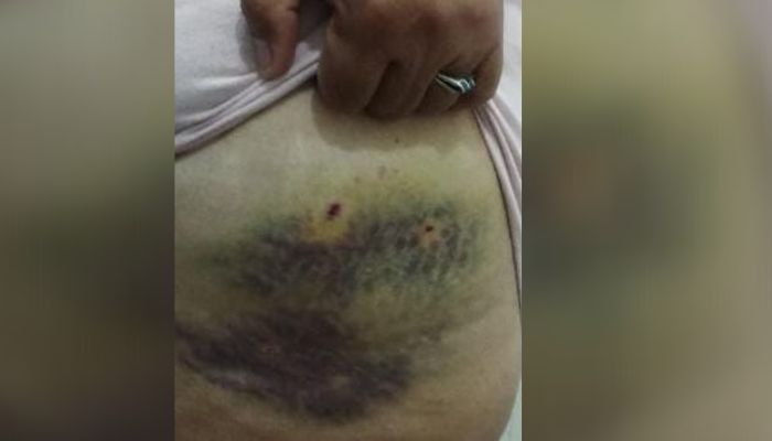 Otra mujer atacada por el perro de Litoral al 700