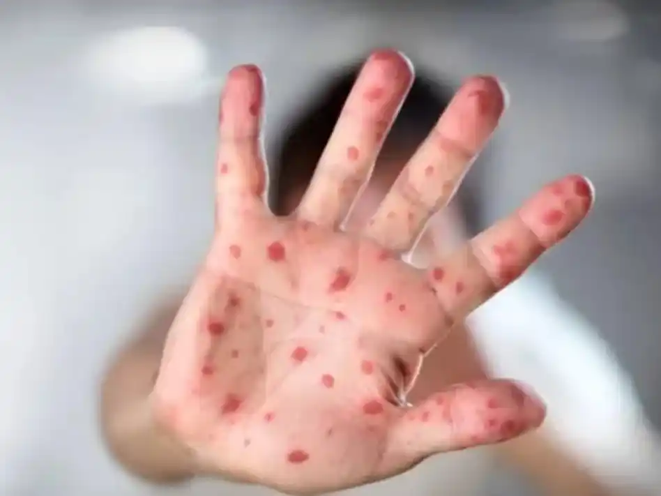 Detectaron el primer caso de viruela del mono de mayor severidad en la Argentina