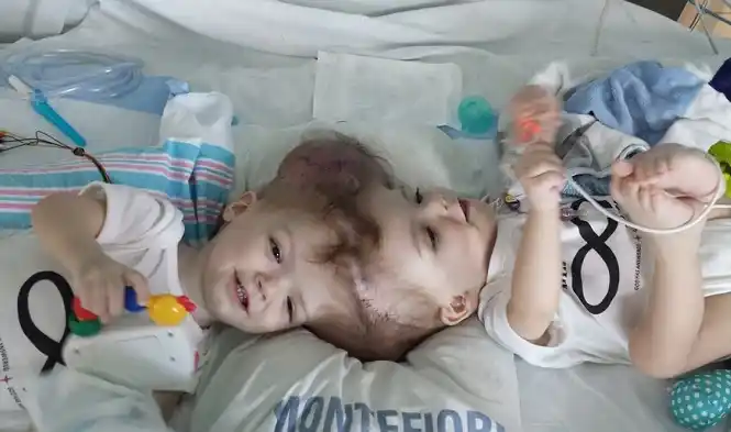 Tras 16 horas de cirugía, separaron a siameses unidos por el cráneo