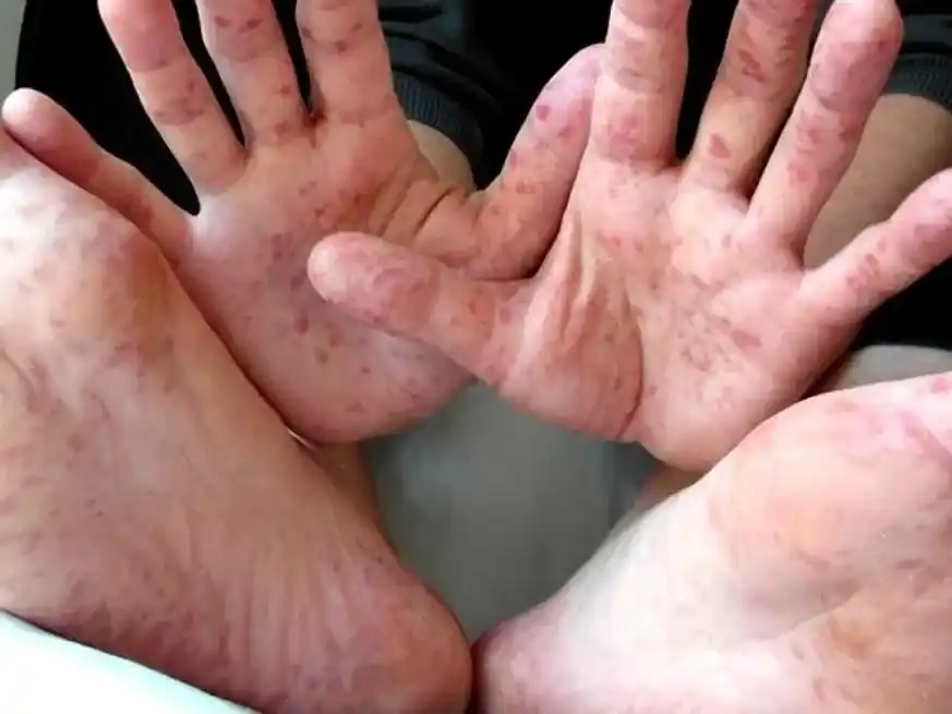 La sífilis es una infección de transmisión sexual.