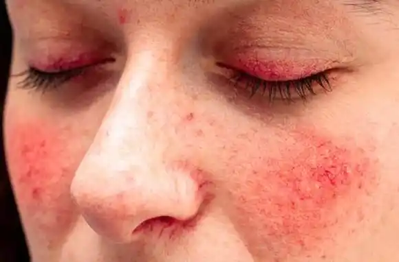 Rosácea: tratamiento y apoyo domicilario