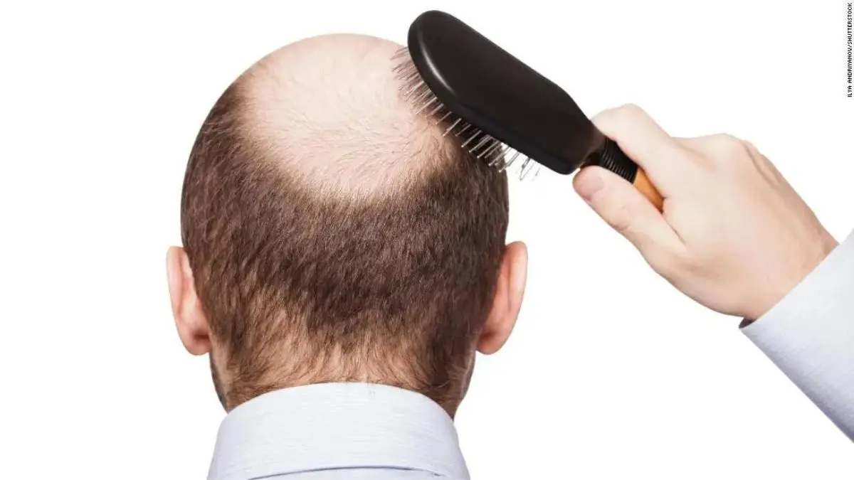 ¿CADA DÍA TIENES MENOS CABELLO?  Estas son las causas de la alopecia