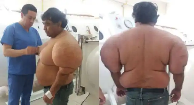 El extraño caso del buzo al que se le deformó el cuerpo después de un accidente 