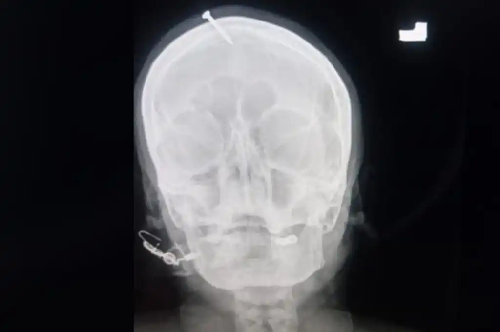 Le martillaron un clavo en la cabeza a embarazada para asegurarse de tener un varón