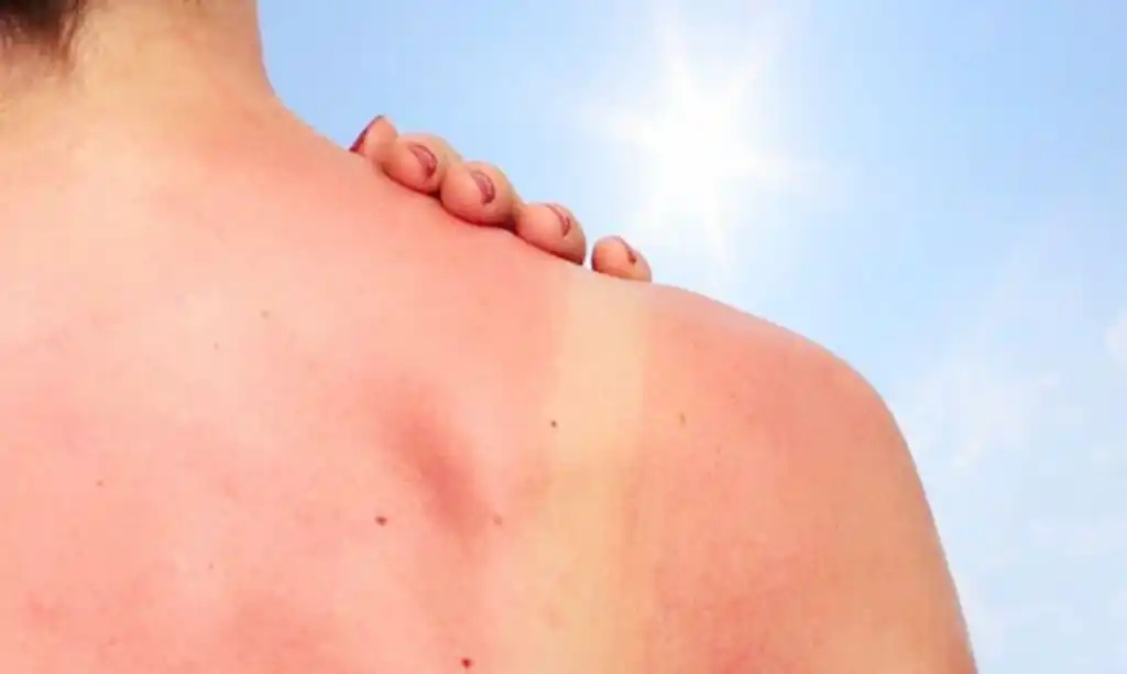 Por año hay entre 2 y 3 millones de nuevos casos  de cáncer de piel en el mundo