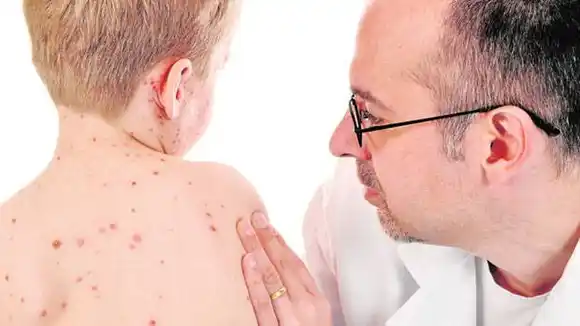 Más sarampión en el mundo, otro efecto de la pandemia de coronavirus