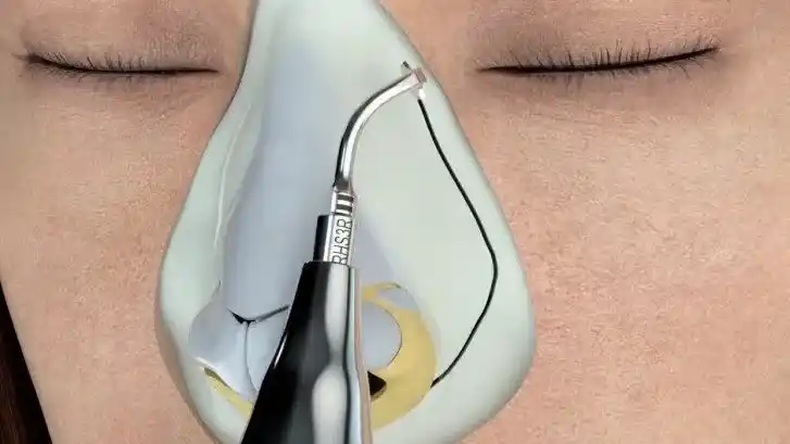 Cómo funciona la rinoplastia ultrasónica y dónde realizarla en Tandil.