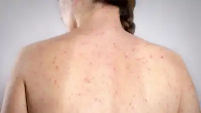 Alerta epidemiológica por nuevos casos de sarampión