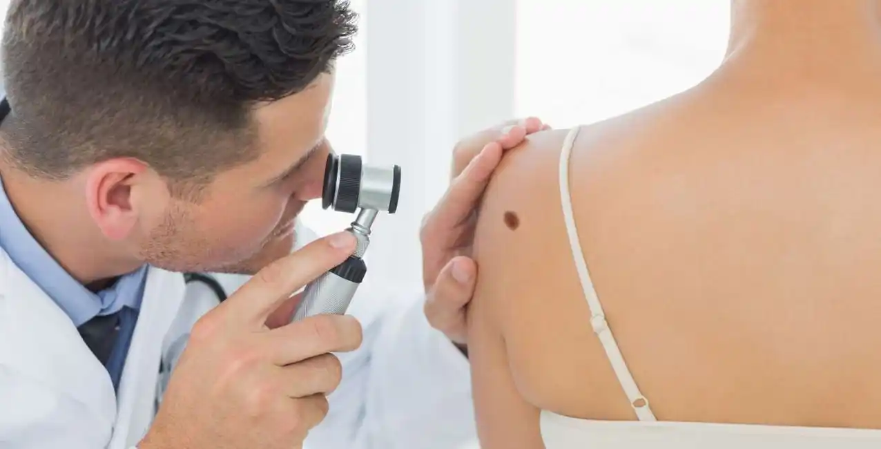 Día Mundial del Melanoma: la importancia de chequear tus lunares