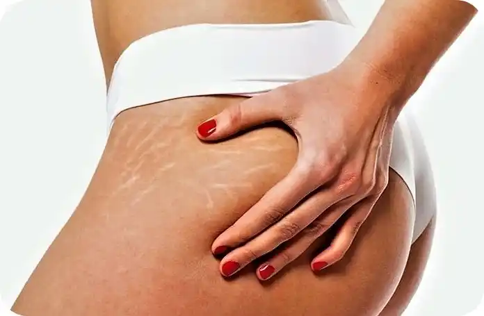 Estrías, un tema que preocupa a todas