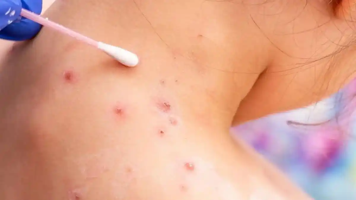 ¡ALERTA! Confirman  2 casos de viruela del mono en Venezuela