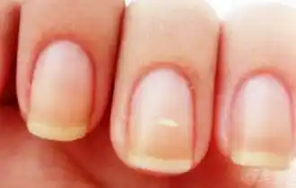 “Odiosas” manchitas blancas en las uñas