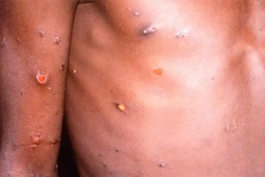 La OMS declaró la emergencia internacional por el avance de la viruela del mono