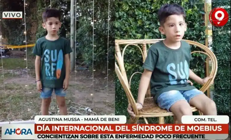La historia de Beni, un niño con síndrome de Moebius
