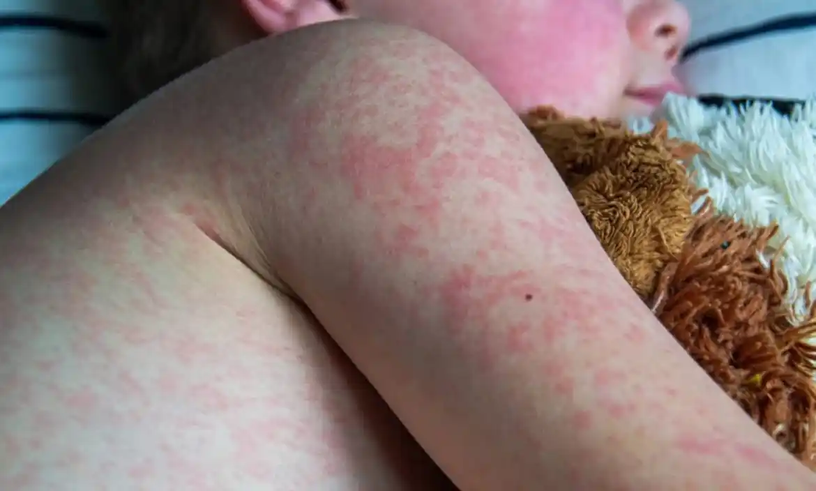 Sarampión: pediatras insisten en vacunar a los más chicos con la Doble y Triple viral