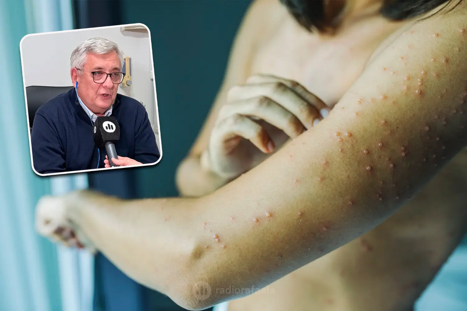 Dr. Gilberto Molinari - médico especializado en pediatría | ¿Qué pasó con los casos de varicela en Rafaela? ¿Cómo debemos actuar? ¿Qué es lo que hay que saber?